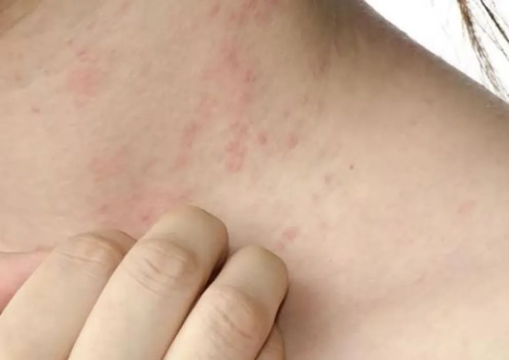 Las alergias a los medicamentos y sus consecuencias